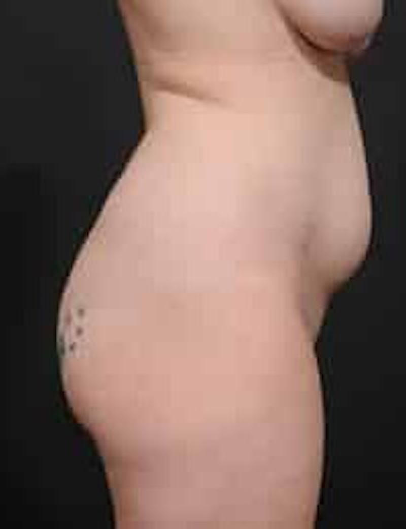 Tummy Tuck Before & After Gallery - Patient 133214397 - Image 5