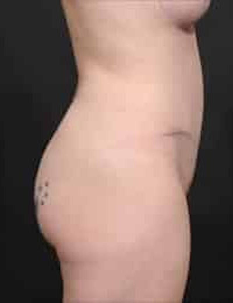 Tummy Tuck Before & After Gallery - Patient 133214397 - Image 6