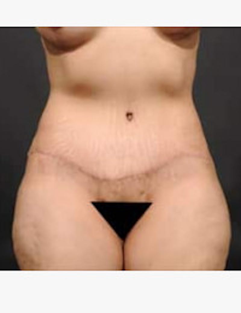 Tummy Tuck Before & After Gallery - Patient 133214399 - Image 2