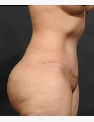 Tummy Tuck Before & After Gallery - Patient 133214399 - Image 4