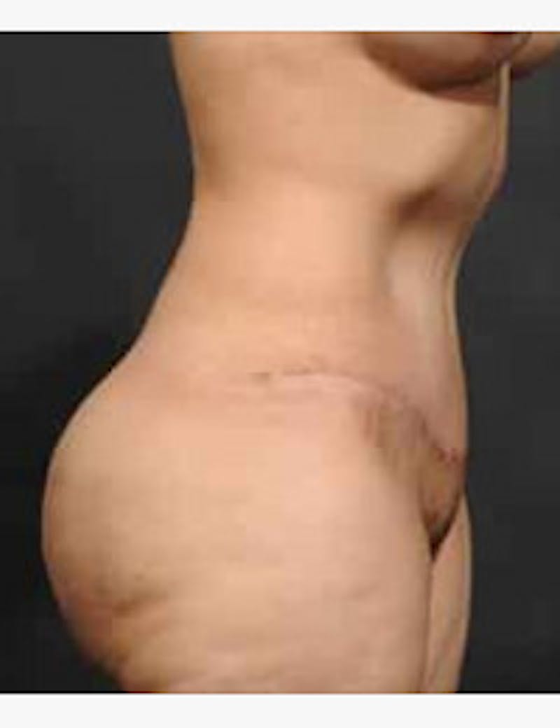 Tummy Tuck Before & After Gallery - Patient 133214399 - Image 4
