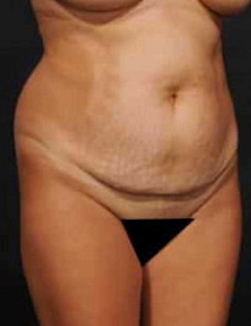 Tummy Tuck Before & After Gallery - Patient 133214402 - Image 3