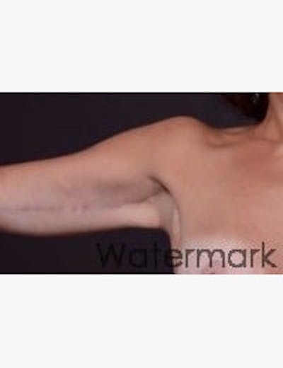 Arm Lift Before & After Gallery - Patient 133214400 - Image 2