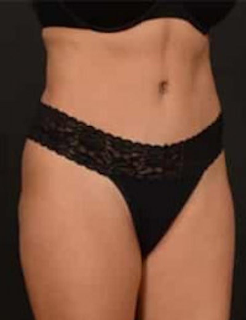 Tummy Tuck Before & After Gallery - Patient 133214402 - Image 4