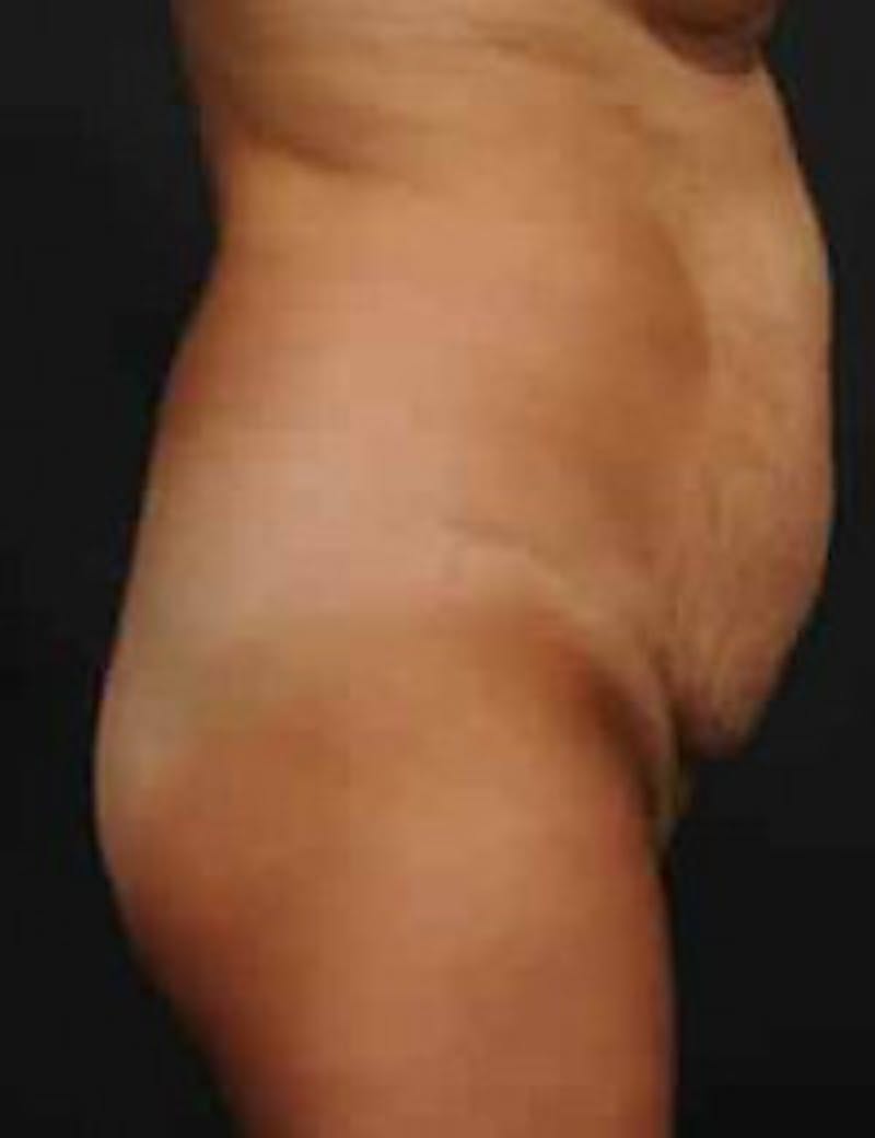 Tummy Tuck Before & After Gallery - Patient 133214402 - Image 5