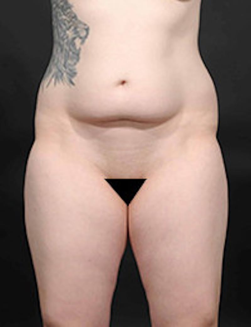 Tummy Tuck Before & After Gallery - Patient 133214403 - Image 1
