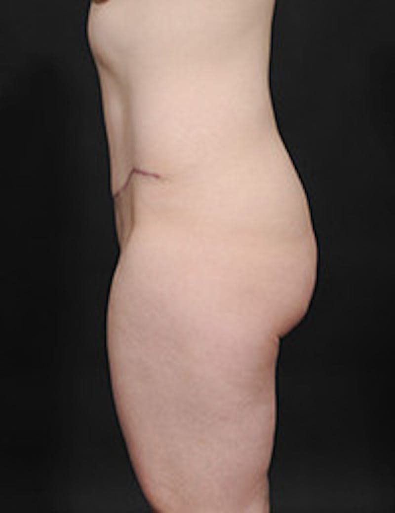 Tummy Tuck Before & After Gallery - Patient 133214403 - Image 4