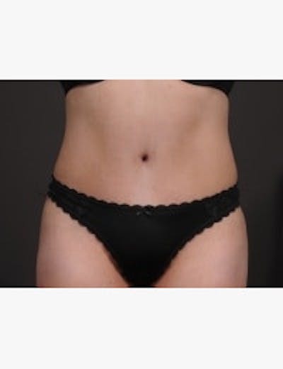Liposuction Before & After Gallery - Patient 133214406 - Image 2