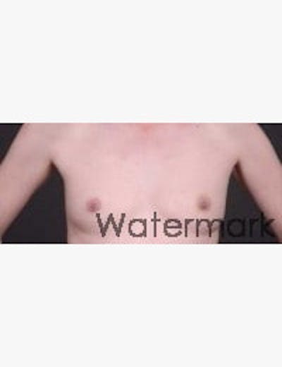 Breast Reconstruction Before & After Gallery - Patient 133214447 - Image 1