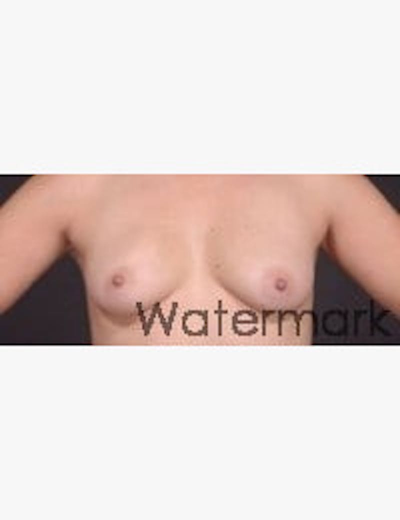 Breast Reconstruction Before & After Gallery - Patient 133214451 - Image 1