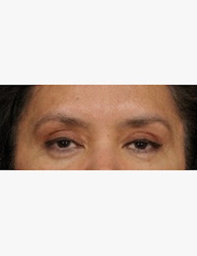 Blepharoplasty Before & After Gallery - Patient 133214452 - Image 1