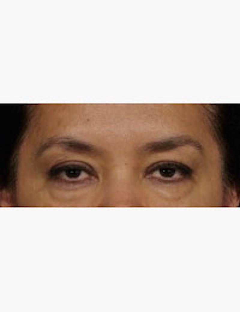Blepharoplasty Before & After Gallery - Patient 133214452 - Image 2