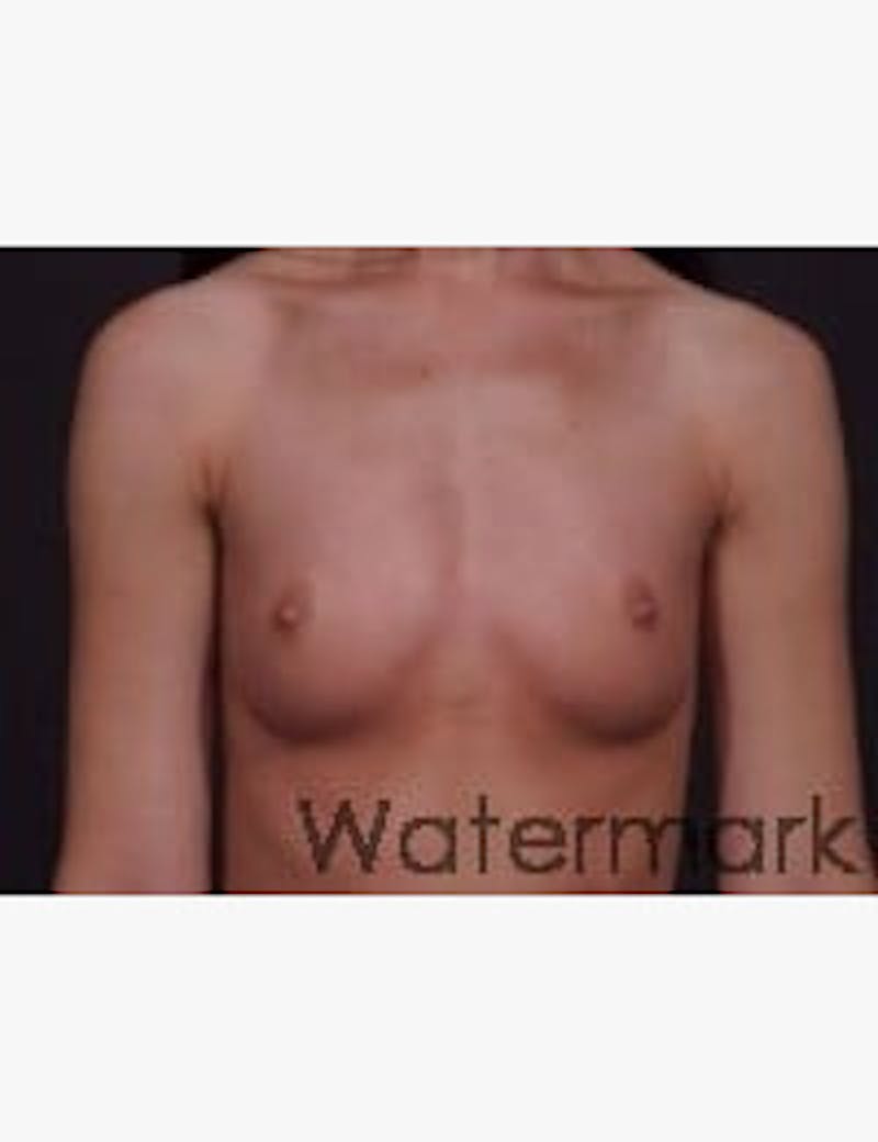 Breast Augmentation Before & After Gallery - Patient 133214453 - Image 1