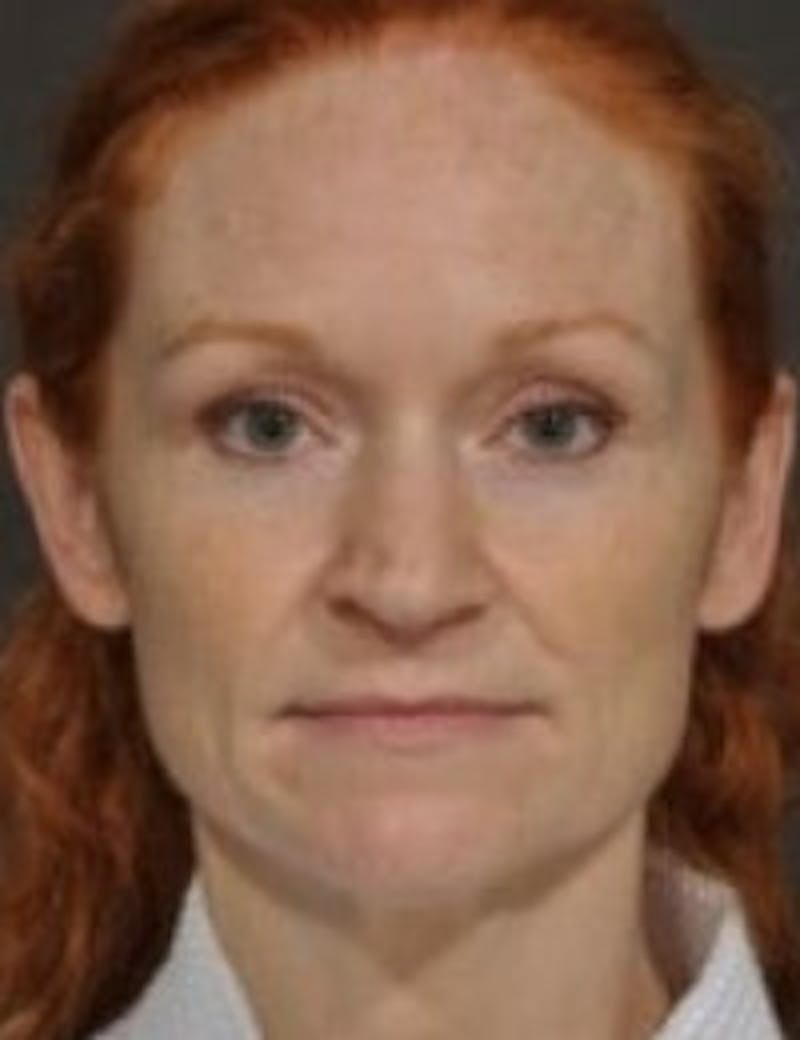 Rhinoplasty Before & After Gallery - Patient 133214473 - Image 1