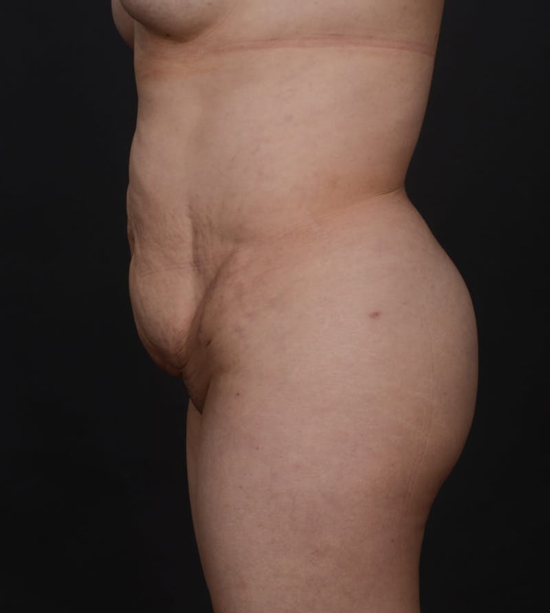 Tummy Tuck Before & After Gallery - Patient 140118169 - Image 5