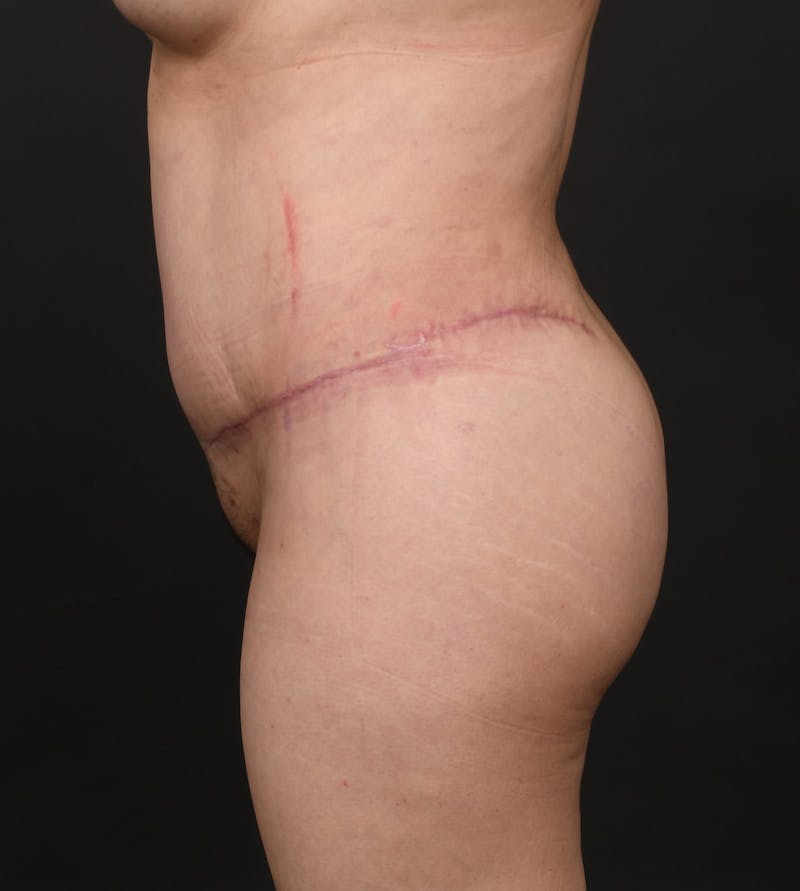 Tummy Tuck Before & After Gallery - Patient 140118169 - Image 6