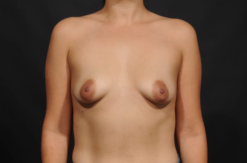 Breast Augmentation Before & After Gallery - Patient 140122077 - Image 1
