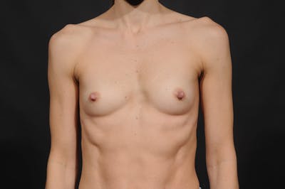 Breast Augmentation Before & After Gallery - Patient 140122274 - Image 1
