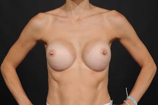 Breast Augmentation Before & After Gallery - Patient 140122274 - Image 4