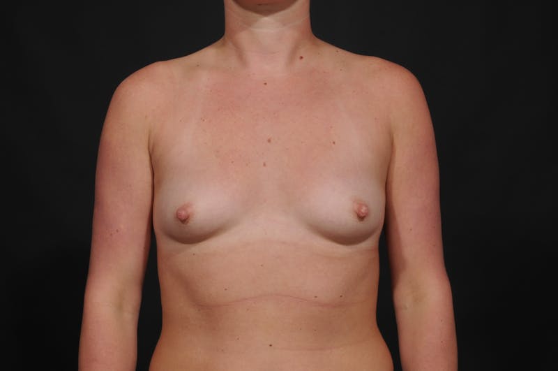 Breast Augmentation Before & After Gallery - Patient 336701 - Image 1