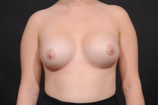 Breast Augmentation Before & After Gallery - Patient 140122673 - Image 2