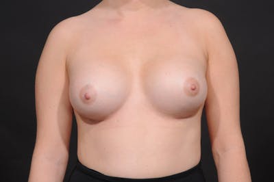 Breast Augmentation Before & After Gallery - Patient 140122673 - Image 2