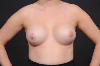Breast Augmentation Before & After Gallery - Patient 140122673 - Image 4