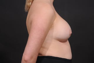 Breast Augmentation Before & After Gallery - Patient 140122673 - Image 8