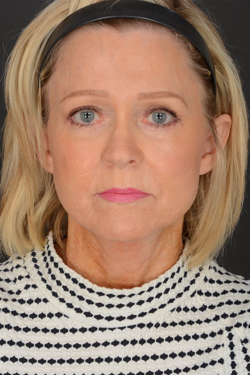 Facelift Before & After Gallery - Patient 140123207 - Image 2