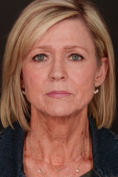Facelift Before & After Gallery - Patient 140123207 - Image 1