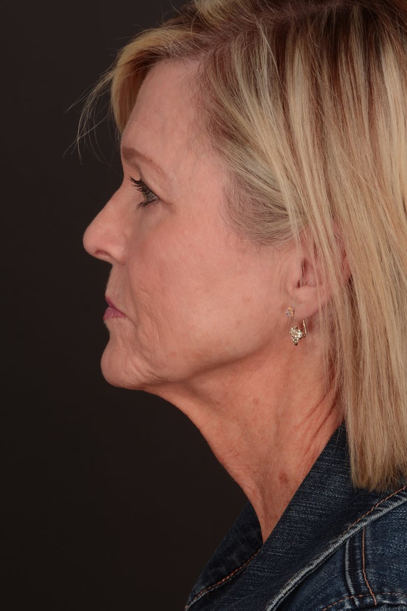 Facelift Before & After Gallery - Patient 140123207 - Image 7