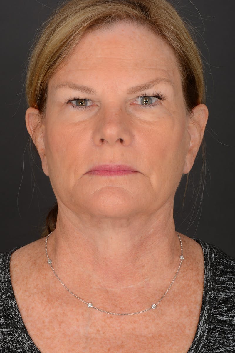 Neck Lift Before & After Gallery - Patient 140123240 - Image 6