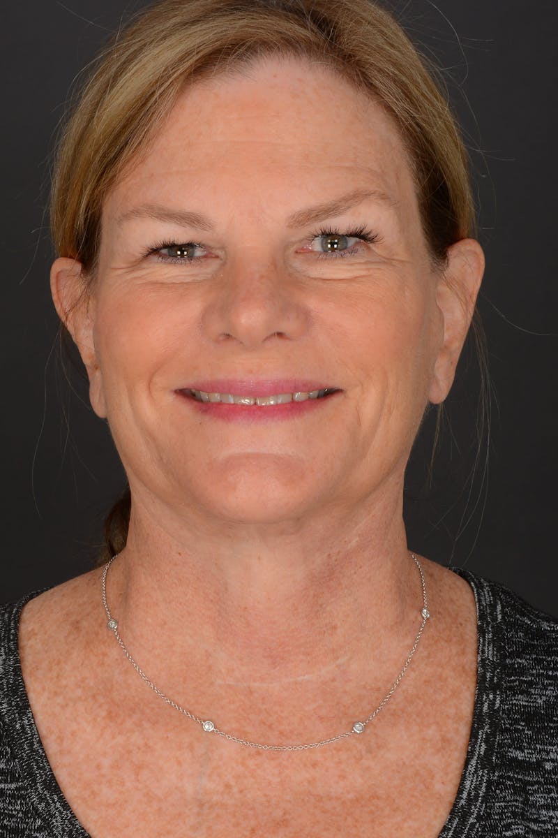 Neck Lift Before & After Gallery - Patient 140123240 - Image 8