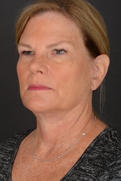 Neck Lift Before & After Gallery - Patient 140123240 - Image 2