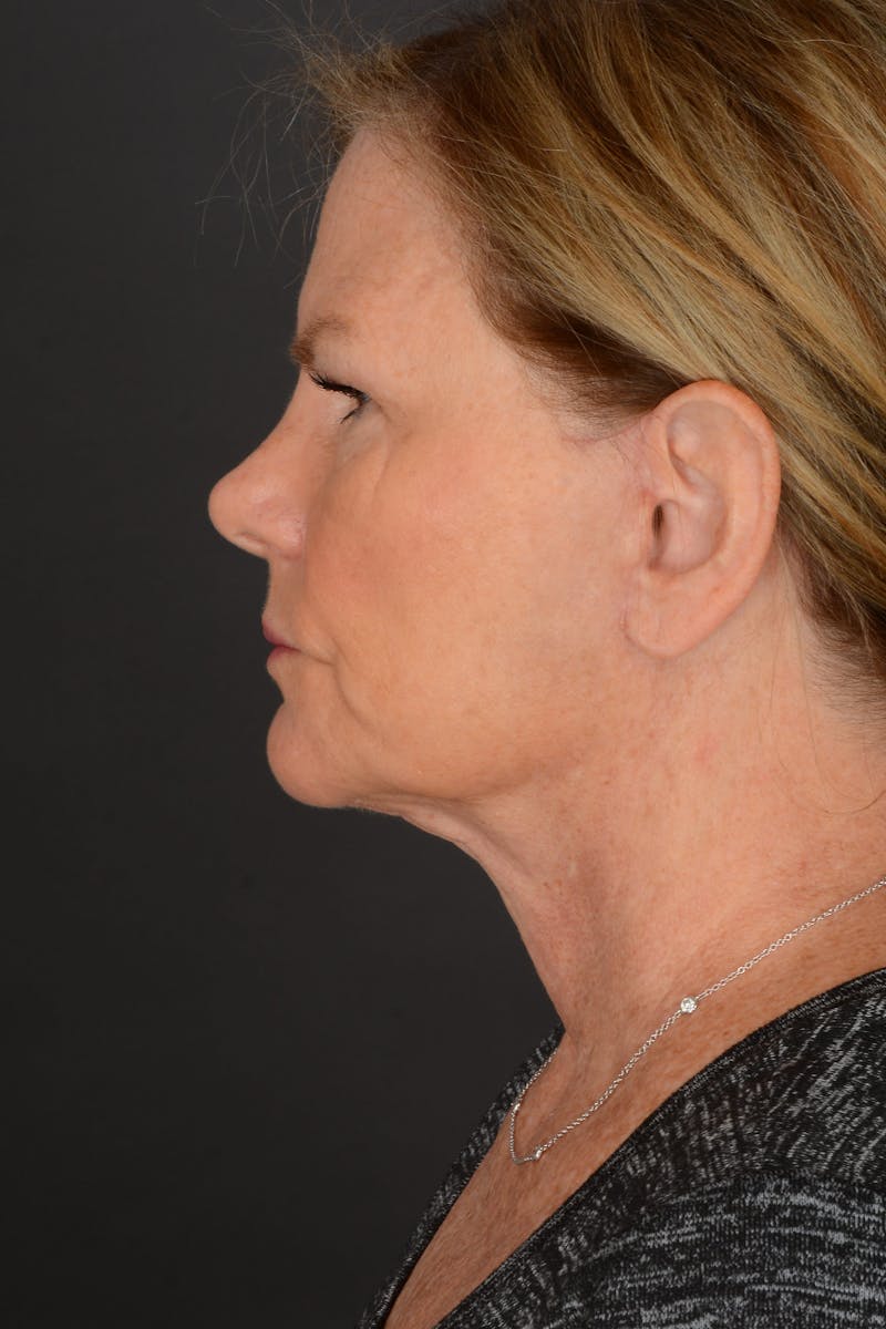 Neck Lift Before & After Gallery - Patient 140123240 - Image 4