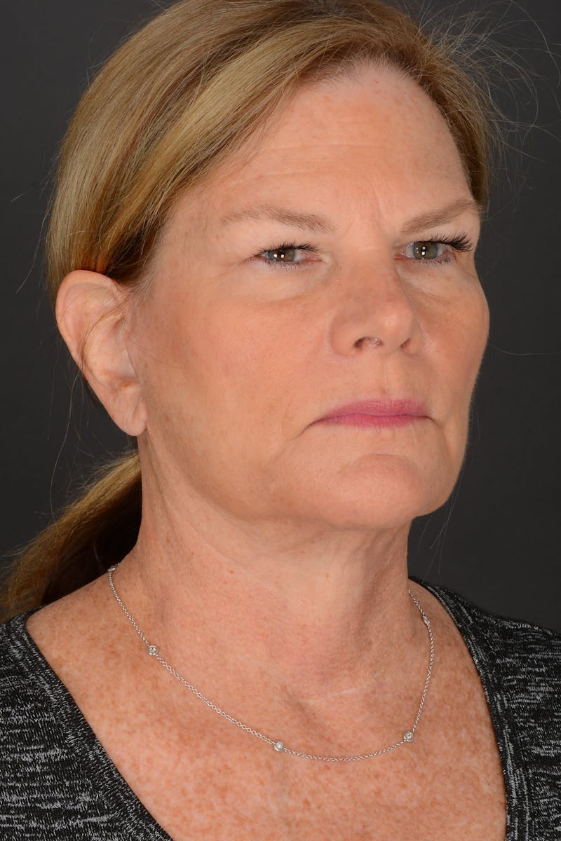 Neck Lift Before & After Gallery - Patient 140123240 - Image 10