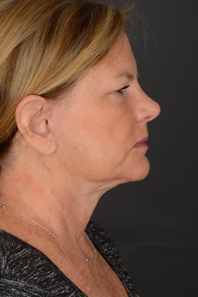Neck Lift Before & After Gallery - Patient 140123240 - Image 12