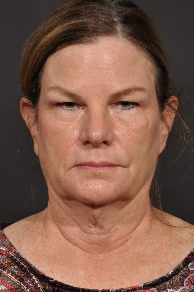 Neck Lift Before & After Gallery - Patient 140123240 - Image 5