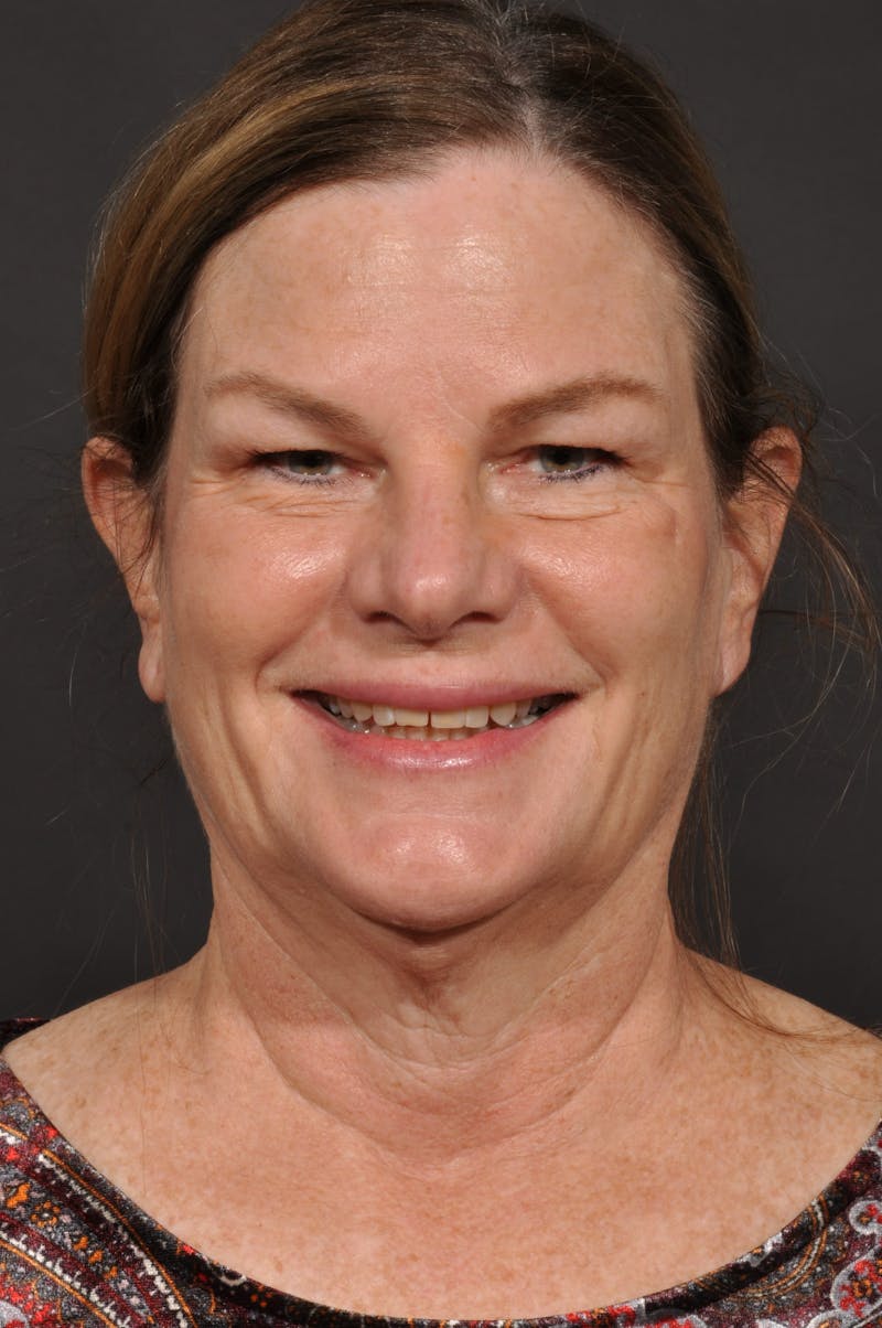 Neck Lift Before & After Gallery - Patient 140123240 - Image 7
