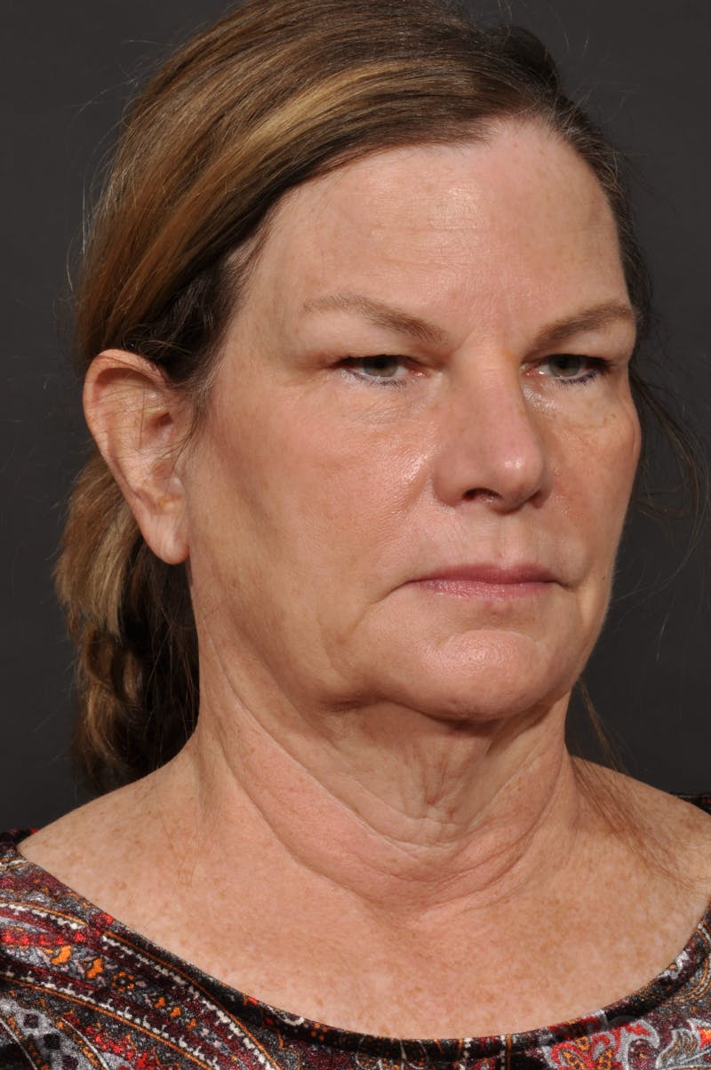 Neck Lift Before & After Gallery - Patient 140123240 - Image 9