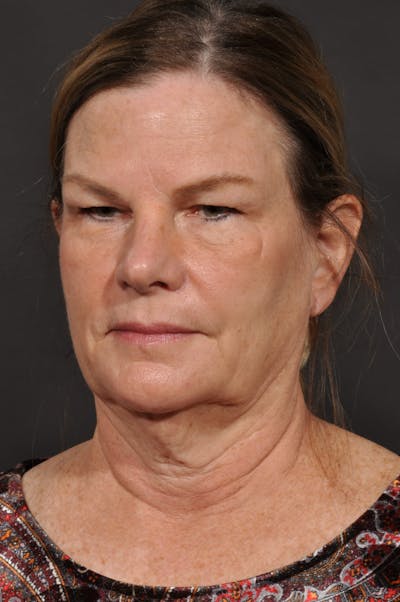Neck Lift Before & After Gallery - Patient 140123240 - Image 1