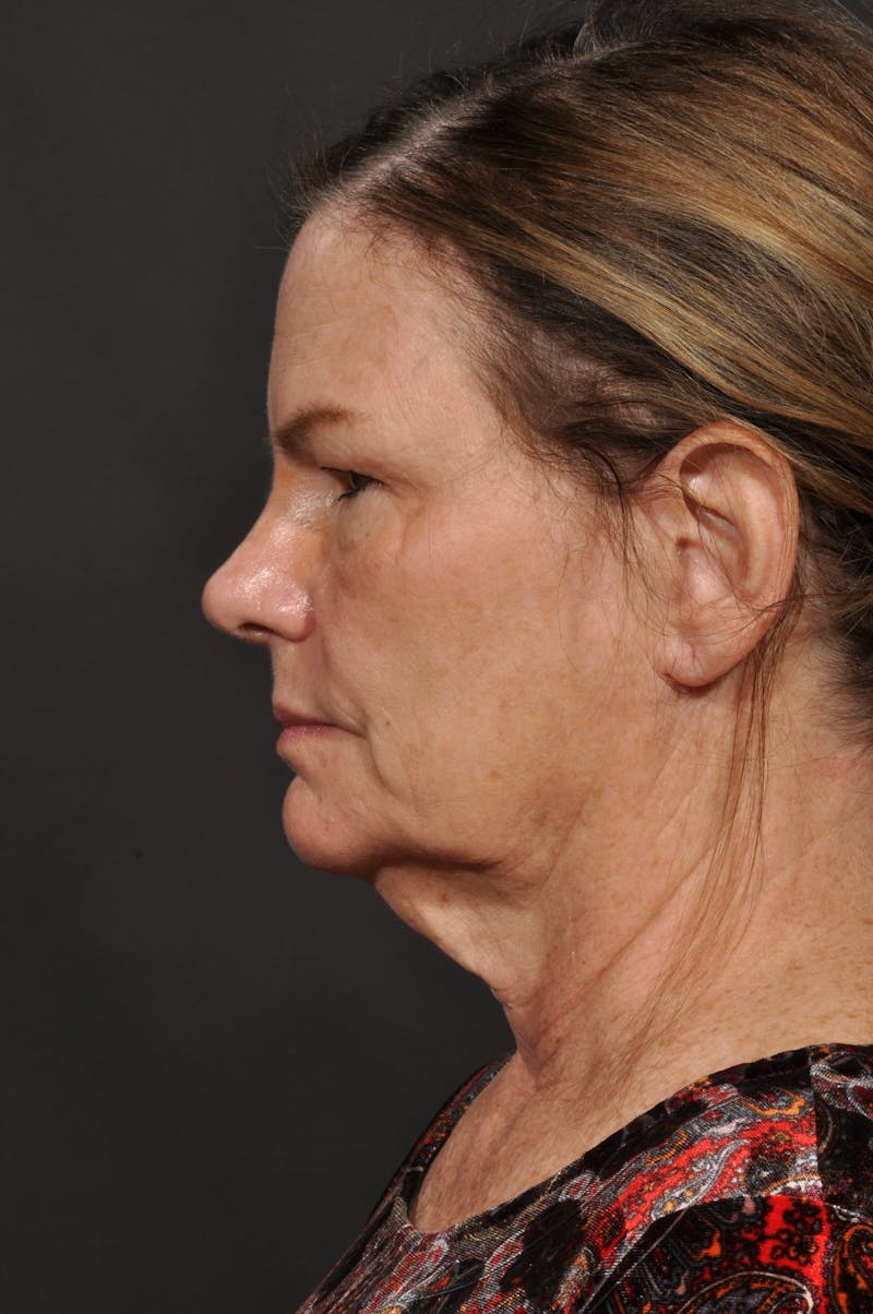 Neck Lift Before & After Gallery - Patient 140123240 - Image 3