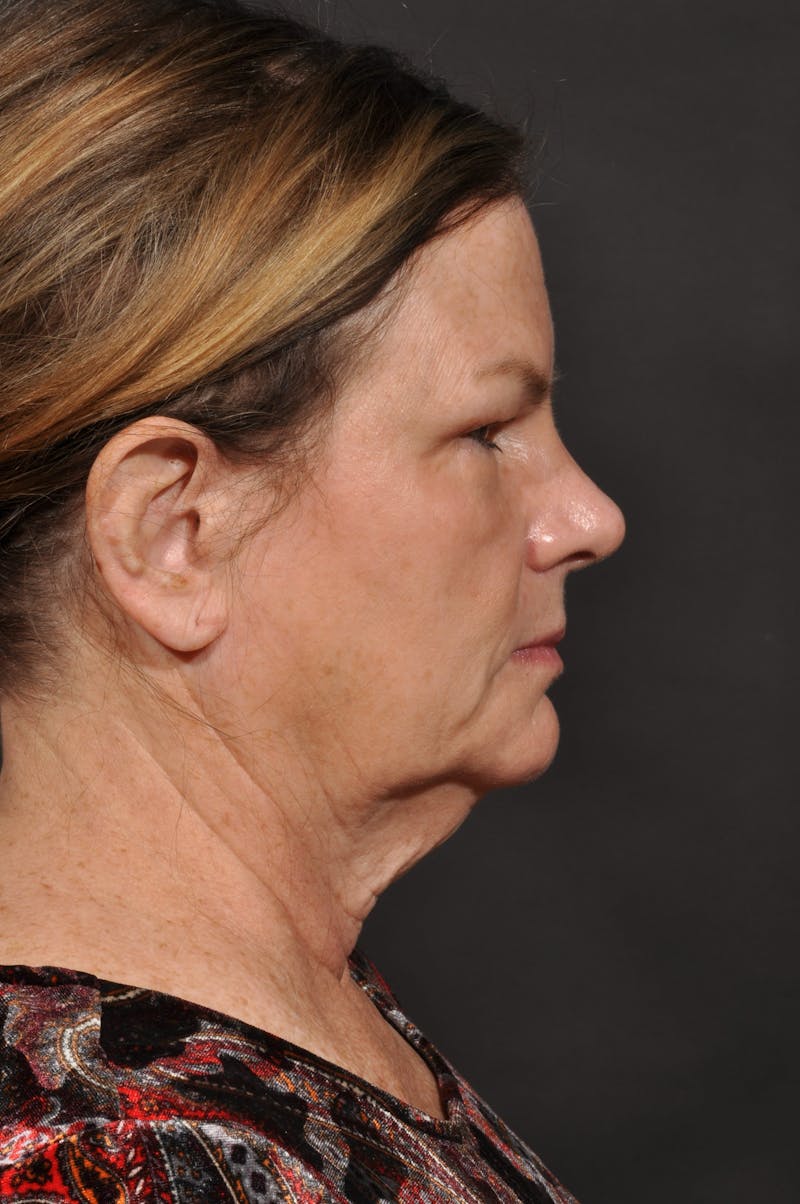 Neck Lift Before & After Gallery - Patient 140123240 - Image 11
