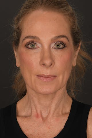 Rhinoplasty Before & After Gallery - Patient 140123247 - Image 4