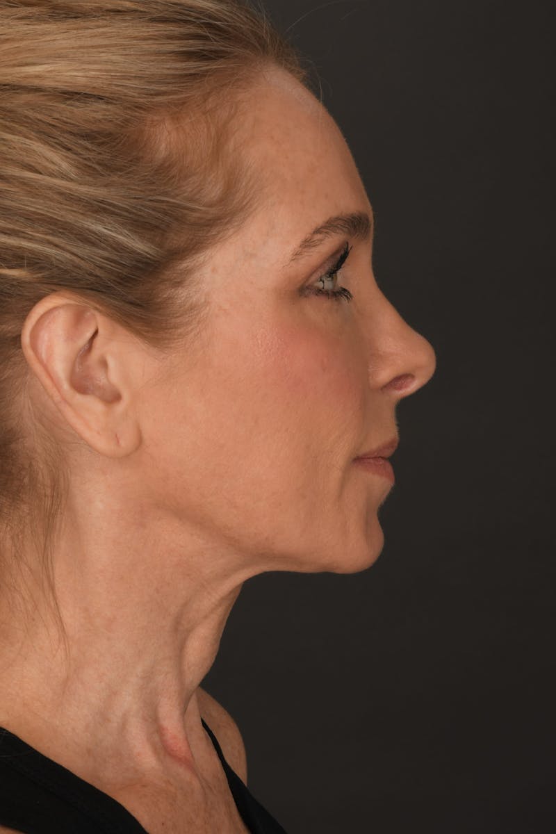 Rhinoplasty Before & After Gallery - Patient 140123247 - Image 10