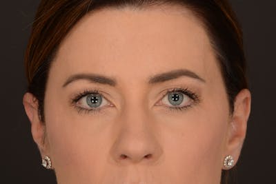 Blepharoplasty Before & After Gallery - Patient 140123278 - Image 1