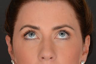 Blepharoplasty Before & After Gallery - Patient 140123278 - Image 4