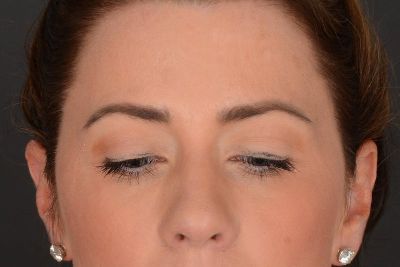 Blepharoplasty Before & After Gallery - Patient 140123278 - Image 6