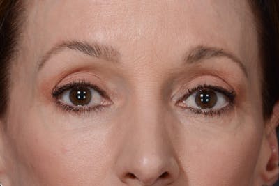 Blepharoplasty Before & After Gallery - Patient 140123277 - Image 2