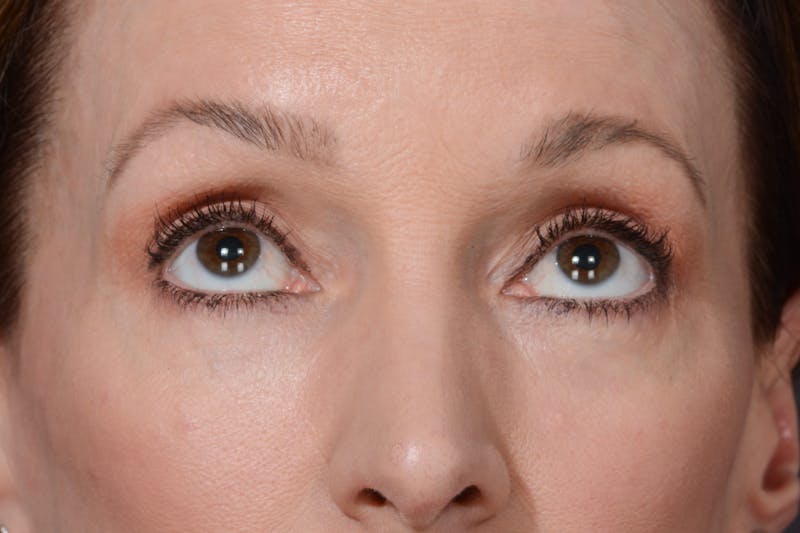 Blepharoplasty Before & After Gallery - Patient 140123277 - Image 4